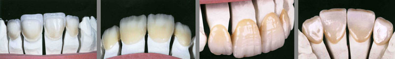 Advanced Dental Prosthetics