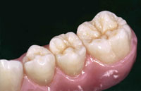 Advanced Dental Prosthetics